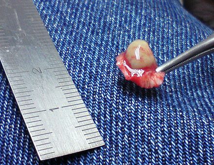 A 7 mm plantar wart surgically removed from the sole of a person's foot after other treatments failed