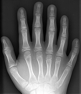 Supernumerary body part Growth of an additional part of the body and a deviation from the body plan