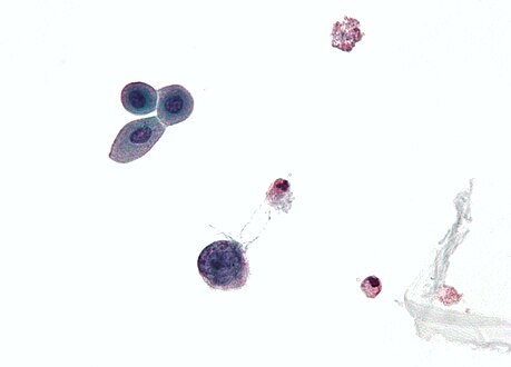 Micrograph showing a polyomavirus infected cell — large (blue) cell below-center-left. Urine cytology specimen.