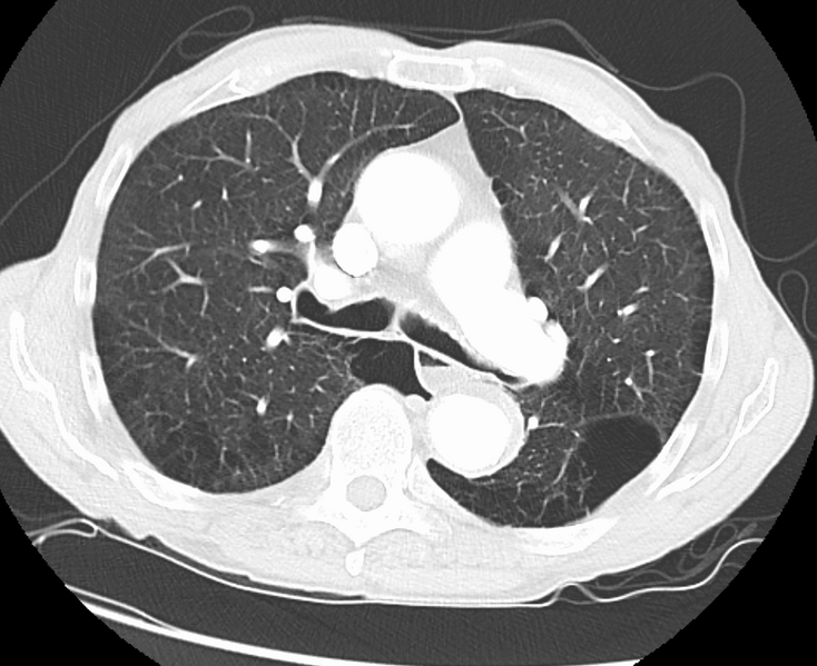 File:PulArtHyperandEmphysema.png