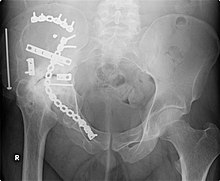 This image, taken in September 2006, shows extensive repair work to the right acetabulum six years after it was carried out (2000). The onset of arthritis, a bone/joint disease, has made further joint damage visible. Repair-of-fracture-to-right-acetabulum.jpg