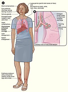 Löfgren syndrome Medical condition