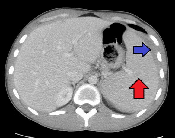 Splenomegaly due to mononucleosis resulting in a subcapsular hematoma