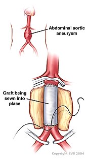 <span class="mw-page-title-main">Open aortic surgery</span> Surgical technique