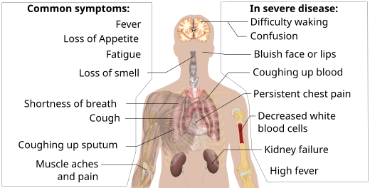 Symptoms of COVID-19