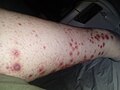 Miniatura para Archivo:Vasculitis on legs 2.jpg