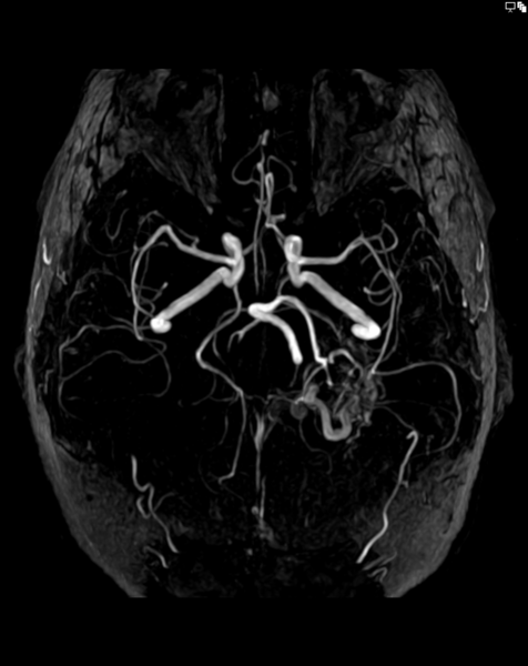 File:001 Arteriovenous Malformation MRT TOF MIP 10.png