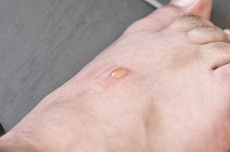 File:01082013 - Blister on feet.jpg