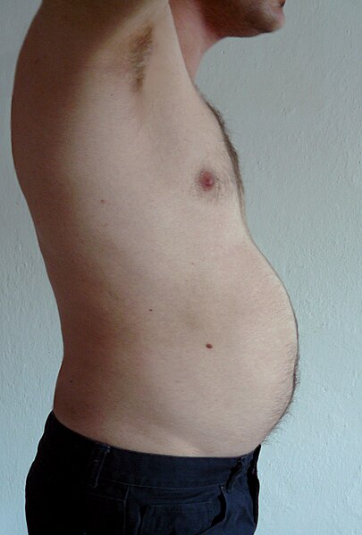 Abdominal obesity in a man ("beer belly")