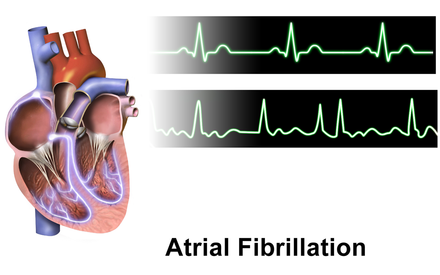 Normal rhythm tracing (top) Atrial fibrillation (bottom)