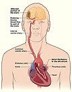 Atrial fib stroke.jpg