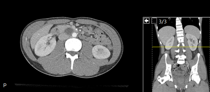 CT of a normal abdomen and pelvis, axial plane 127.png