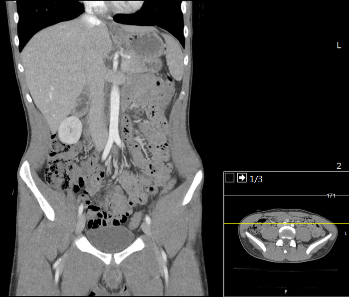 CT of a normal abdomen and pelvis, coronal plane 55.png