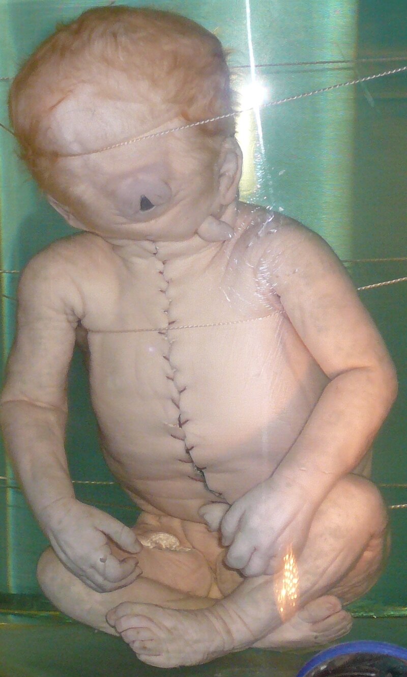 800px-Child_with_Cyclopia.jpg