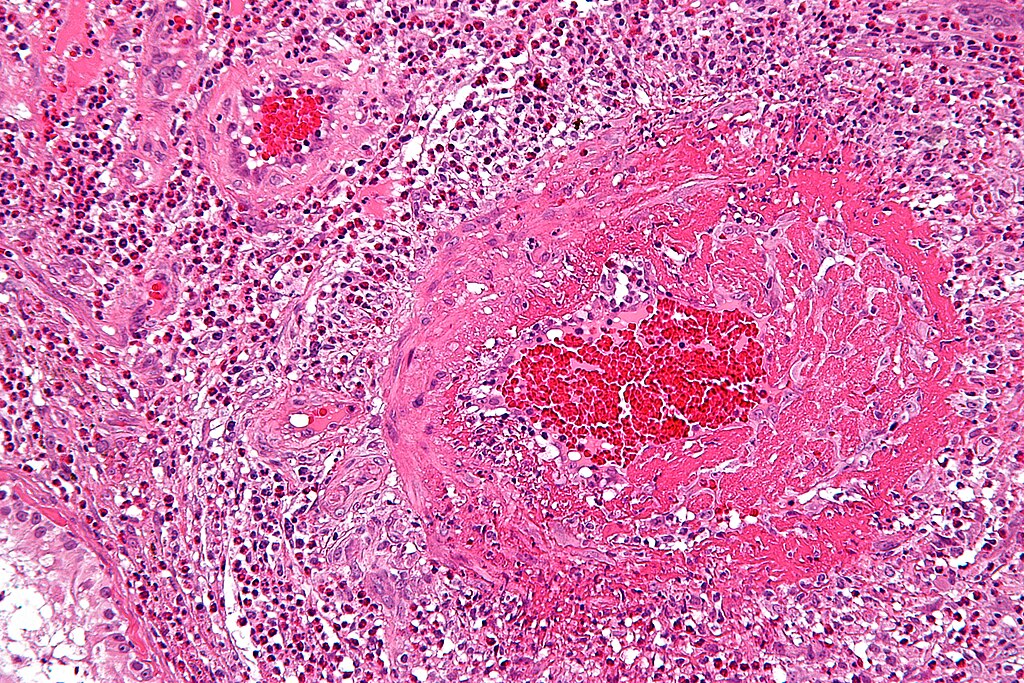 صورة مجهرية تظهر التهاب وعائي يوزيني لحالة متلازمة شيرغ ستراوس. الصورة بصبغة H&E.