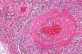 <span class="mw-page-title-main">Eosinophilic granulomatosis with polyangiitis</span> Medical condition