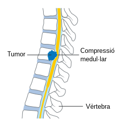 File:Diagram showing a tumour causing spinal cord compression CRUK 081-ca.svg