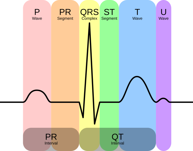 First-degree atrioventricular block - Wikipedia