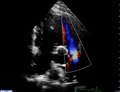 File:Echocardiographic-imaging-of-tricuspid-and-pulmonary-valve-abnormalities-in-primary-ovarian-1476-7120-8-37-S5.ogv