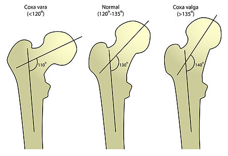 Different femoral abnormalities.
