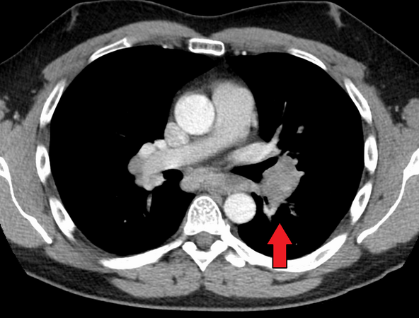 Hilar adenopathy especially on the person's left (transverse CT)
