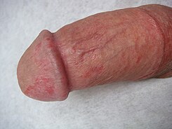 Inflammation of the glans penis and the preputial mucosa.jpg
