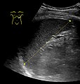 Maximum length of spleen on abdominal ultrasonography