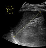 Maximum dimension of the spleen on abdominal ultrasonography. Maximum length of spleen on ultrasonography.jpg