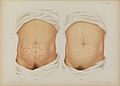 Plate XXXVII, torsos with lesions Prince Albert Morrow, 1889 Wellcome L0074349.jpg