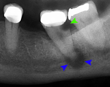 Green arrows indicate tooth decay. Blue arrows indicate abscess at root of tooth. The infection at the root of the tooth can travel through bone and infect surrounding soft tissue. Tooth decay and abscess xray.png