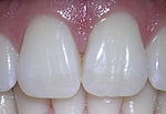 Thumbnail for Dhëmbët prerës (dens incisivus)