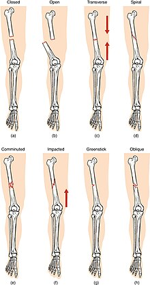 transverse fractures