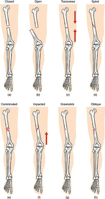 Different types of fractures