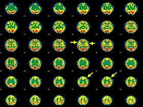 Affective psychosis, Hashimoto's thyroiditis, and brain perfusion abnormalities.jpg