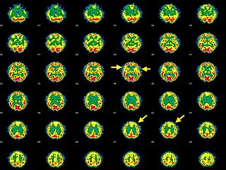 <span class="mw-page-title-main">Hashimoto's encephalopathy</span> Human disease (neurological condition)