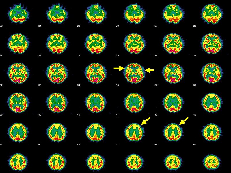 File:Affective psychosis, Hashimoto's thyroiditis, and brain perfusion abnormalities.jpg