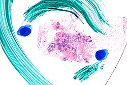 Atypical ductal hyperplasia - sangat rendah mag.jpg