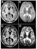 Thumbnail for Subacute sclerosing panencephalitis