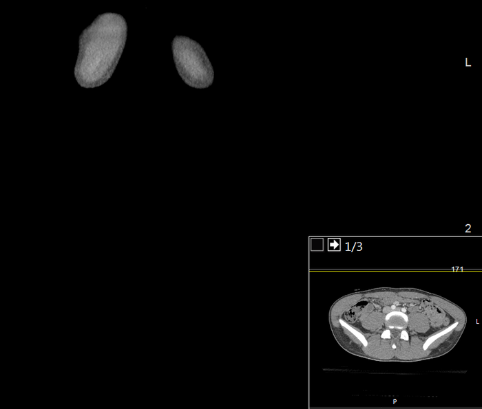 CT of a normal abdomen and pelvis, coronal plane 3.png