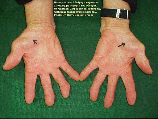 Carpal Tunnel Syndrome, thenar atrophy