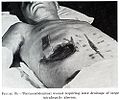 Chapter3figure39-Thoracoabdominal wound.jpg
