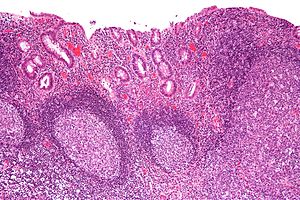 Proctite da deviazione - intermed mag.jpg