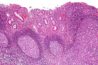 Diversion colitis Medical condition