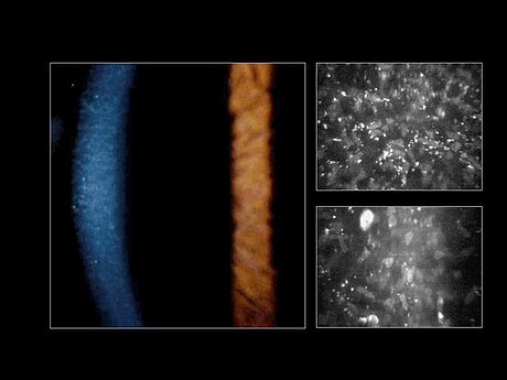 Fleck corneal dystrophy