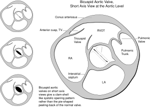 bicuspid aortic valve