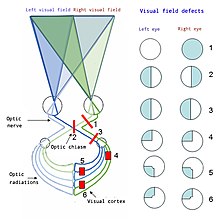 Ураження зорових шляхів зверху вниз: 1. Повна втрата зору на праве око 2. Бітемпоральна геміанопія 3. Одноіменна геміанопія 4. Квадрантанопія 5. & 6. Квадрантанопія з макулярним щадінням