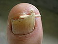 Ingrown toenail toothpick.jpg