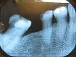 Thumbnail for Bone destruction patterns in periodontal disease