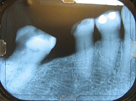 This X-ray film displays a horizontal defect. Mand Right Premolar PA.JPG