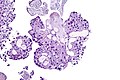 Papillary urothelial carcinoma (high-grade), high mag2